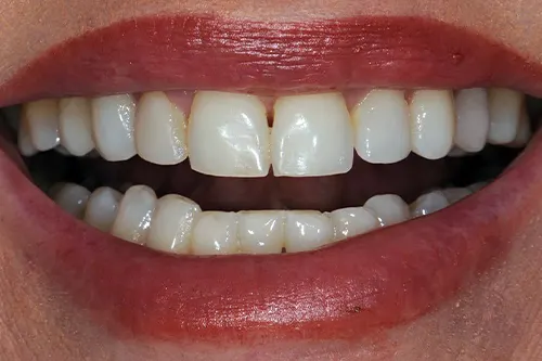 Cosmetic Dentist Buckhead Results